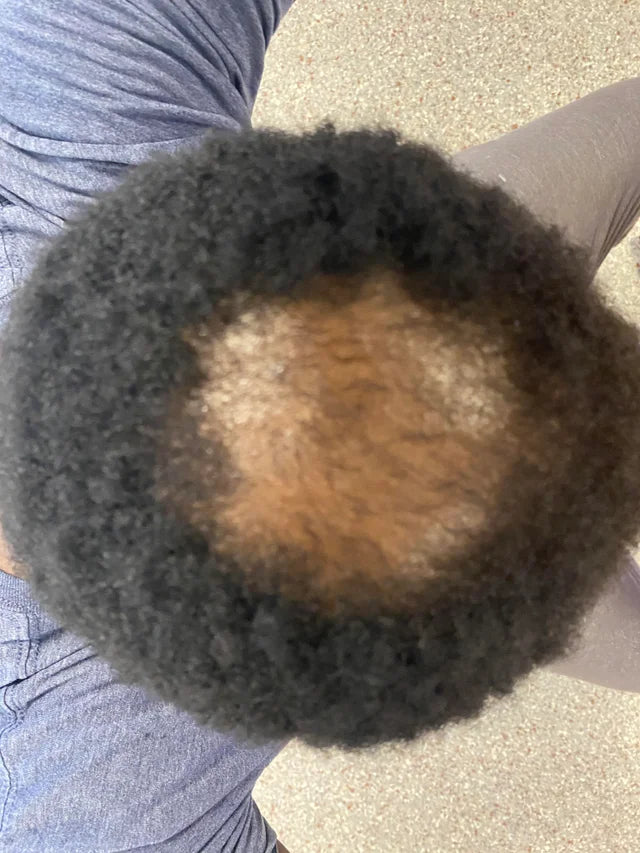 These Things Are Causing The Bald Spots in Your Beard